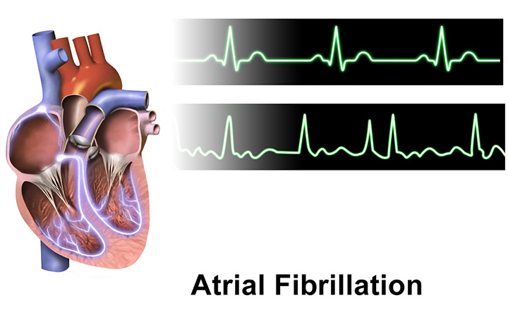 illustration of heart rate and heart anatomy atrial fibrillation